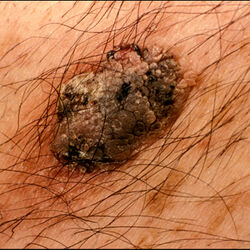 Example of skinLumpsAndBumps